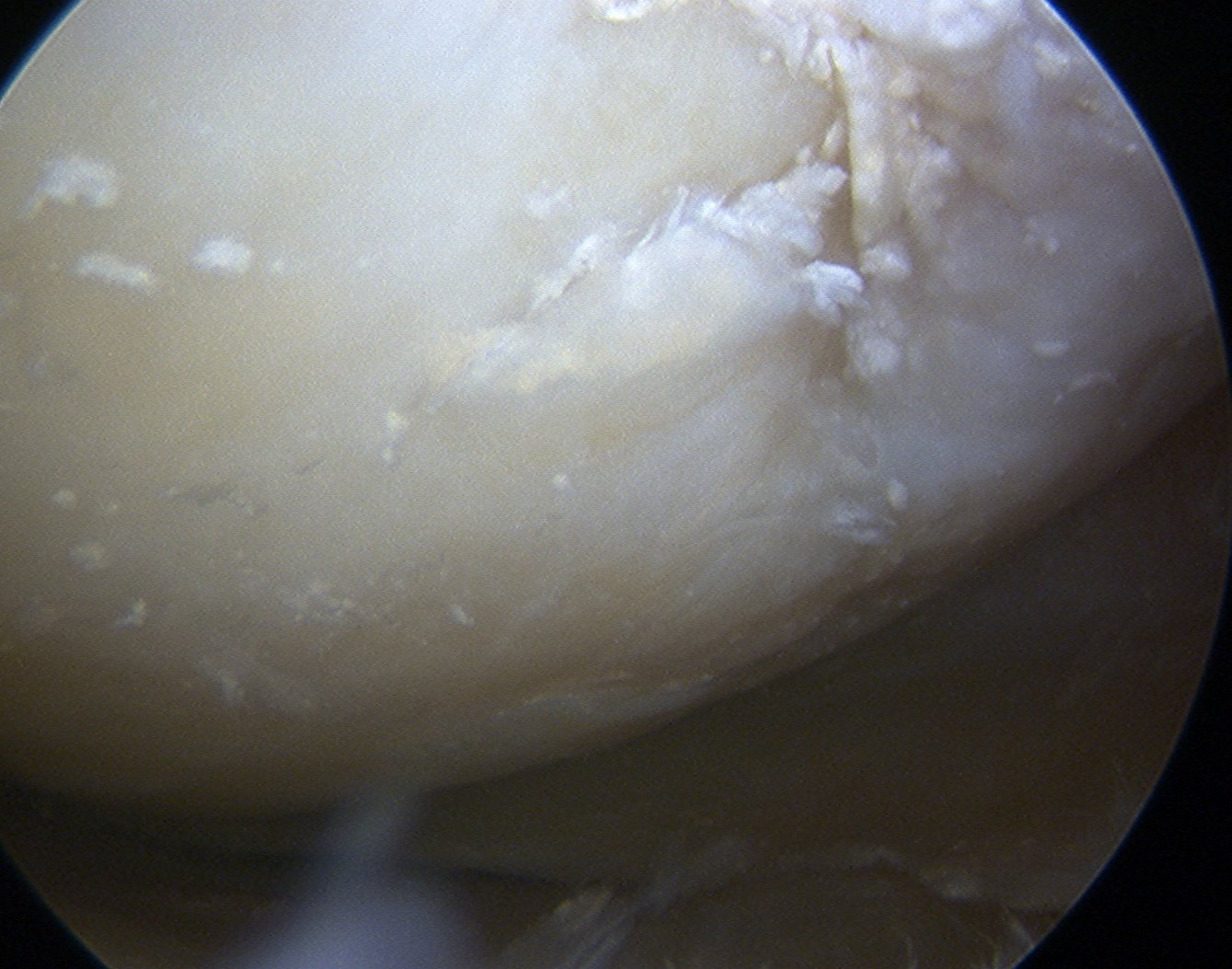 Chondrocalcinosis Knee